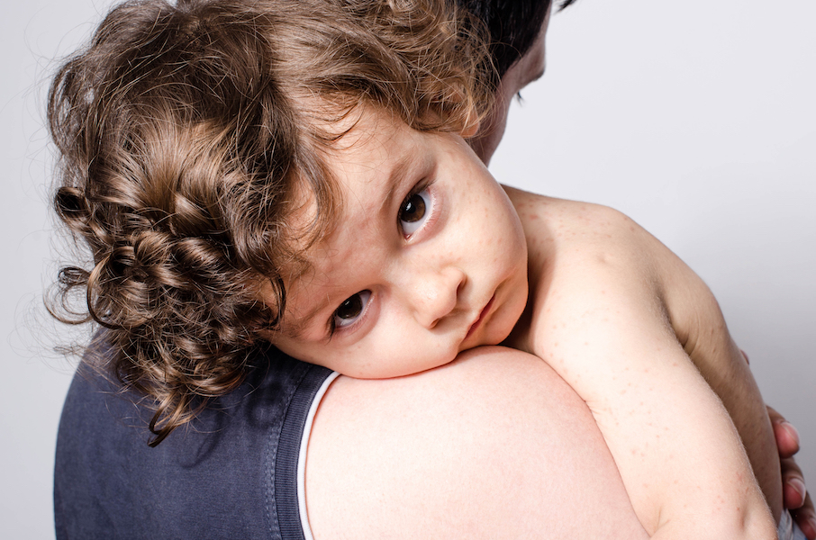 Father holding a cute sick baby boy. Adorable upset child with spots on his face and body form illness mosquito bites roseola rubella measles resting on his parent shoulder.